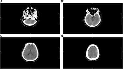 A case report of successful rescue using veno-arterial extracorporeal membrane oxygenation: managing cerebral-cardiac syndrome